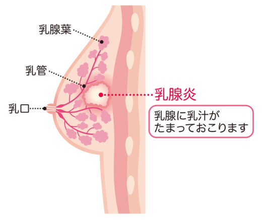 と い 押す パ 痛い しこり おっ