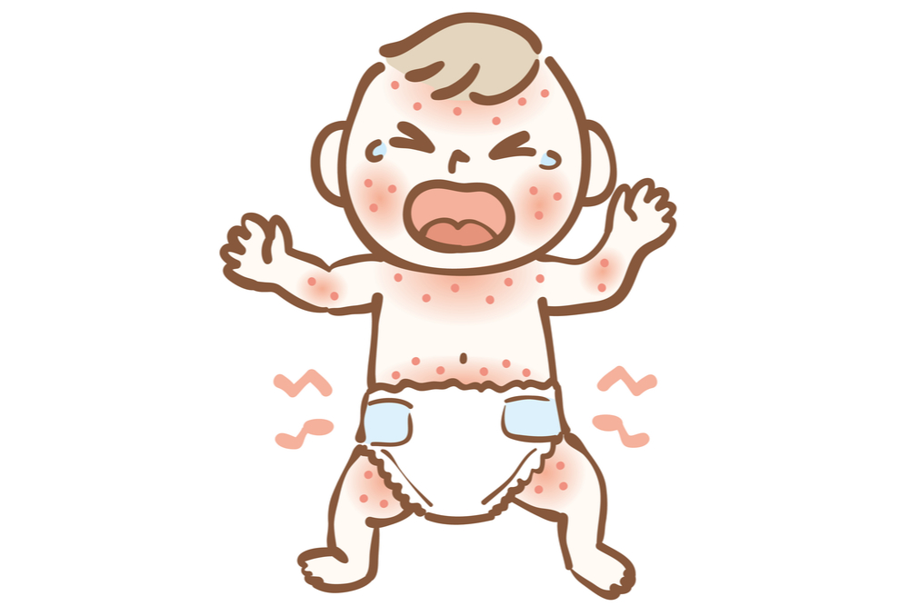 赤ちゃん 背中 湿疹